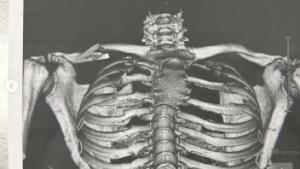 MotoGP 2025: Martinator Terkapar (Lagi). Ini Situasi Terkininya